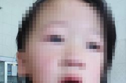Bé gái 4 tuổi bị thanh sắt đâm xuyên miệng trong lúc vui đùa