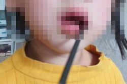 Phẫu thuật lấy thanh sắt đâm vào khoang miệng bé gái 4 tuổi