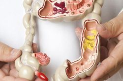 Liệu pháp cấy ghép phân lần đầu tiên được cấp phép trị nhiễm trùng do vi khuẩn