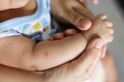 Sốt xuất huyết ở trẻ sơ sinh dễ nhầm với bệnh khác