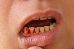 Đã có hơn 300 nghìn ca mắc sốt xuất huyết, 115 ca tử vong