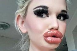 Dù nguy hiểm đến tính mạng, cô gái vẫn tiêm filler môi 32 lần