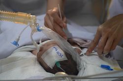Bé trai chào đời với chiếc đầu vẹo do khối bướu khổng lồ