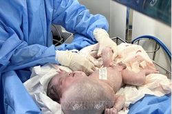 Tách thành công khối bướu nặng hơn 1kg cho cháu bé sơ sinh 3 ngày tuổi