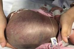 Bé trai vừa chào đời đã bị khối bứu hiếm gặp, to gần bằng cơ thể chèn đường thở