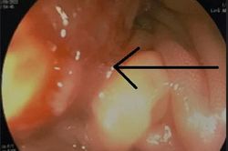 Cứ tưởng đau bụng bình thường, vào viện bé 15 tuổi mới biết mắc ung thư