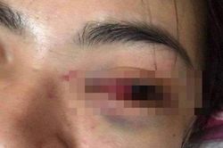 Nữ sinh ở Hà Tĩnh bị nhóm bạn đánh hội đồng dẫn đến tụ máu mắt