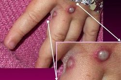 Mỹ sẽ chấm dứt tuyên bố đậu mùa khỉ là tình trạng khẩn cấp tạm thời