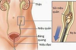 Kỹ thuật tán sỏi tiết niệu ngoài cơ thể bằng laser và những lưu ý cho người bệnh
