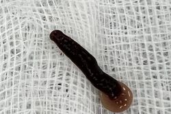 Gắp con đỉa dài 5cm ra khỏi mũi bệnh nhân