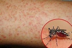 Số ca mắc sốt xuất huyết tại Bình Định tăng đột biến