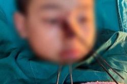 Nỏ tự chế cướp cò, bé trai bị bốn mũi tên sắt đâm vào mặt
