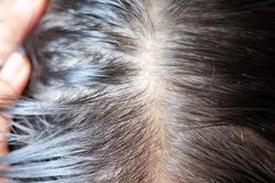 5 lý do không tưởng khiến bạn 'hói' dần