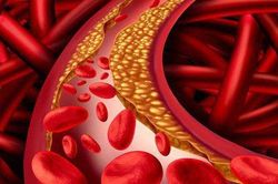 Statin giúp giảm nguy cơ đột quỵ