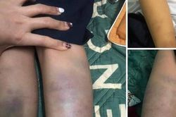 Đà Nẵng: Không khởi tố hình sự vụ 'trẻ lớp 1 bị bầm tím tay chân khi ở trường về'