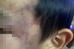 Bé trai 4 tuổi bị con cô giáo đánh tại trường