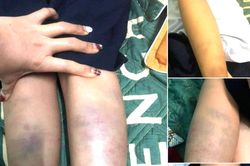 Vì sao không khởi tố hình sự vụ học sinh lớp 1 ở Đà Nẵng bị bầm tím chân tay?