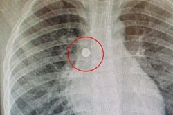 Hơn 1 giờ cứu trẻ 6 tuổi nuốt nhầm pin cúc áo