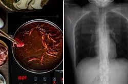 Một cô gái Trung Quốc ăn cay xong bị ho đến mức gãy 4 xương sườn, bác sĩ giải thích ra sao?