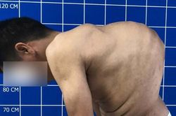 Cắt xương sườn, vén phổi chữa bệnh 'siêu gù' cho người đàn ông