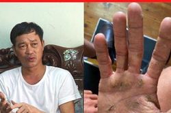 Tuyệt vọng vì viêm da ngứa gãi 'xoành xoạch', xem ngay mẹo này kẻo tiếc!