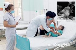 Lấy búi tóc ra khỏi dạ dày bé gái 3 tuổi mắc hội chứng nuốt tóc