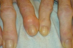 Một loại thuốc trị mụn có thể giúp chữa viêm xương khớp
