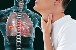 Triệu chứng 'báo động đỏ' ở 70% bệnh nhân ung thư phổi