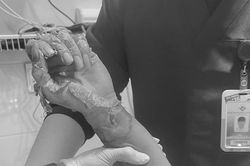 Nam thanh niên bỏng nặng khi đi câu cá