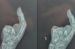 'Trồng' 2 ngón chân vào bàn tay bị máy xay thịt nghiền nát