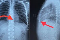 Mua thuốc pháo trên mạng về tự chế, một thiếu niên bị thương nặng