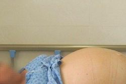 Người phụ nữ khốn khổ mang khối u buồng trứng to như mang song thai
