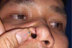 Người đàn ông phát hiện ung thư chỉ từ sẩn đỏ ở cánh mũi