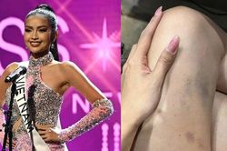 Ngọc Châu lộ đôi chân bầm tím ở Miss Universe 2022