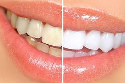 Răng bạn có vàng ố tới mấy cũng trắng ngay lập tức khi dùng chanh cách này