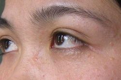 Hết ngay mụn thịt chỉ với 1 củ tỏi