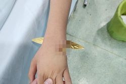 Bị thanh kim loại đâm xuyên thấu cổ tay do ngã khi đi thăm mộ cận Tết