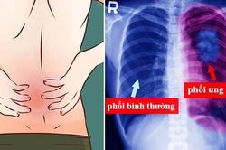 7 dấu hiệu sớm của ung thư phổi rất nhiều người bỏ qua, nguy hiểm nhất là số 5