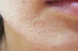 Hướng dẫn hạn chế tình trạng da bong tróc hiệu quả