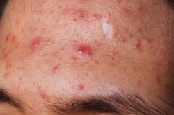 Cách giúp bạn phòng ngừa mụn trên trán