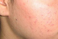 Bí quyết để cả ngày Tết da không hề nổi mụn