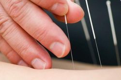 Châm cứu có thể giúp giảm đau trong phẫu thuật ung thư