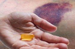 Vết bầm tím không rõ nguyên nhân, cảnh báo thiếu trầm trọng 3 loại vitamin này
