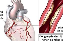 Dấu hiệu và cách phòng ngừa bệnh nhồi máu cơ tim