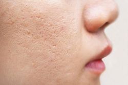 3 phương pháp giúp bạn làm mờ sẹo tại nhà