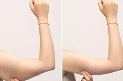Giảm mỡ bắp tay vô cùng hiệu quả