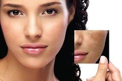 Khắc phục tình trạng da không đều màu