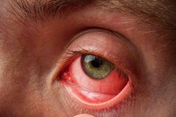 Cách phân biệt viêm kết mạc do virus, vi khuẩn và dị ứng vào mùa Xuân