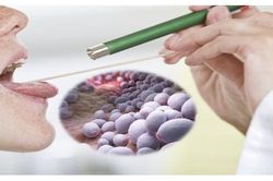 Ho kéo dài, khàn tiếng, khó thở thận trọng với nấm thanh quản