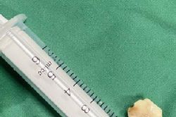 Bị ho suốt 20 ngày, đi khám mới biết có hạt lạc trong phế quản